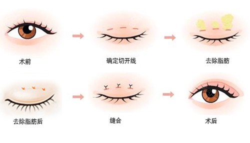 临汾做双眼皮手术原理图