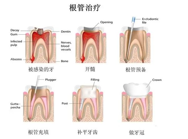 成都根管治疗加牙冠多少钱一颗