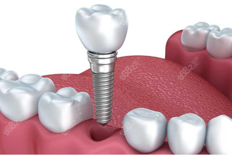 种植牙结构示意图