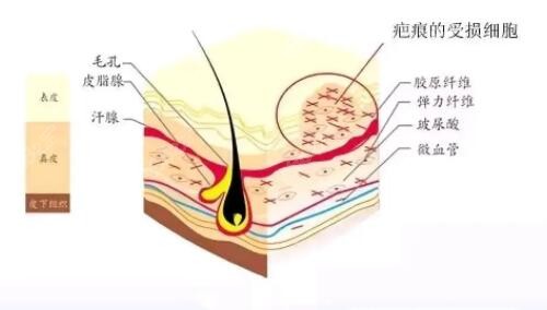 凹陷性疤痕治疗