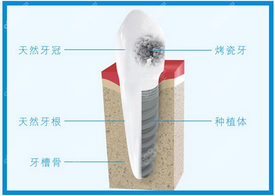 天河区口腔医院种植牙价格