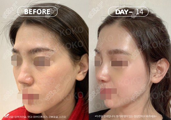 韩国KOKO整形外科驼峰鼻手术+面部脂肪填充对比图