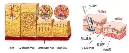 武汉腿部吸脂技术图解