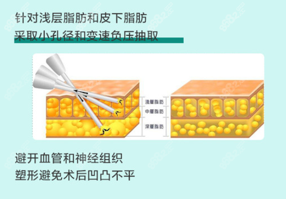 成都恒博天姿李烈吸脂怎么样