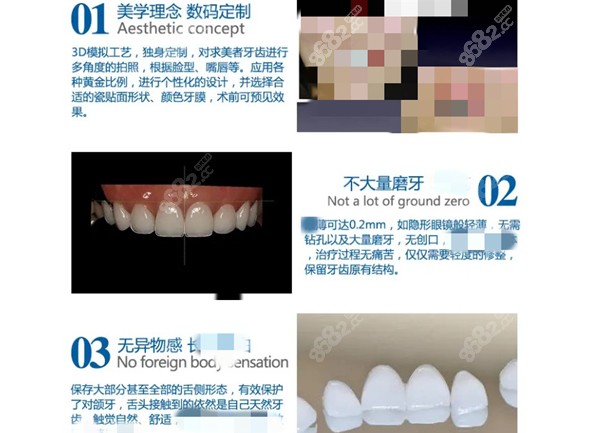 瓷贴面的优势