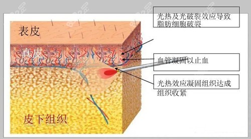 <!--<i data=20240705-sp></i>-->时光吸脂怎么样