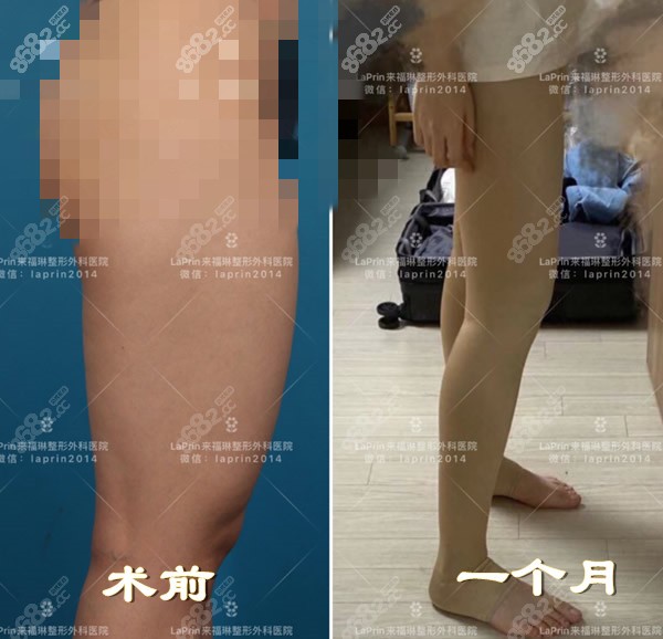 韩国来福琳lappin医院大腿吸脂一个月前后对比照片