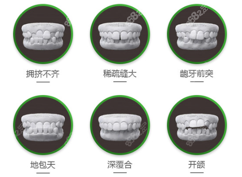 柳州中瑞口腔可以做的牙齿矫正类型