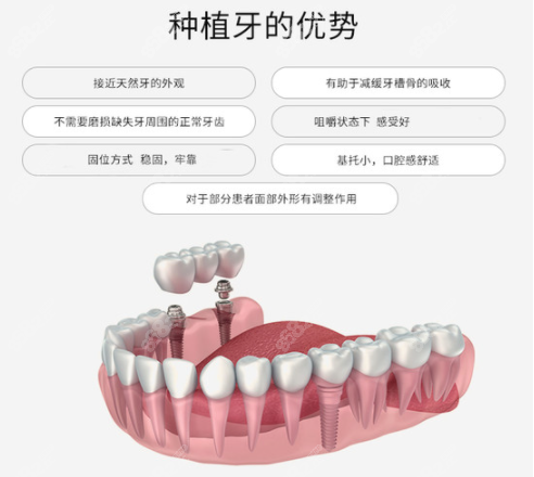 柳州中瑞口腔做种植牙的优势