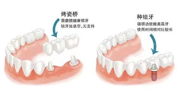 烤瓷桥vs种植牙优缺点对比