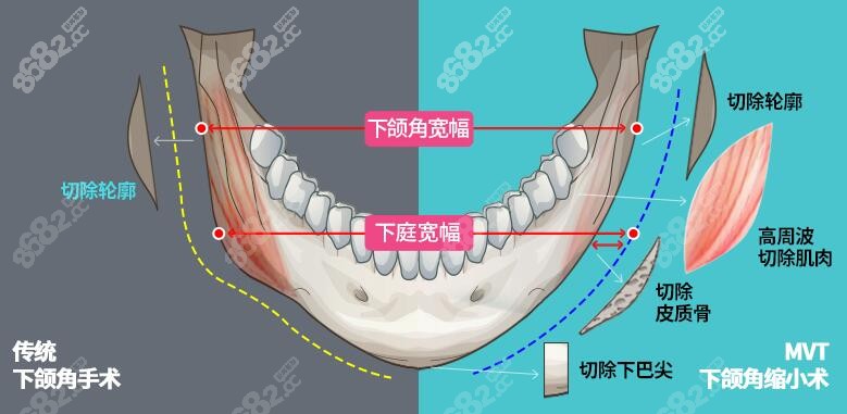 ID下颌角手术和传统手术对比