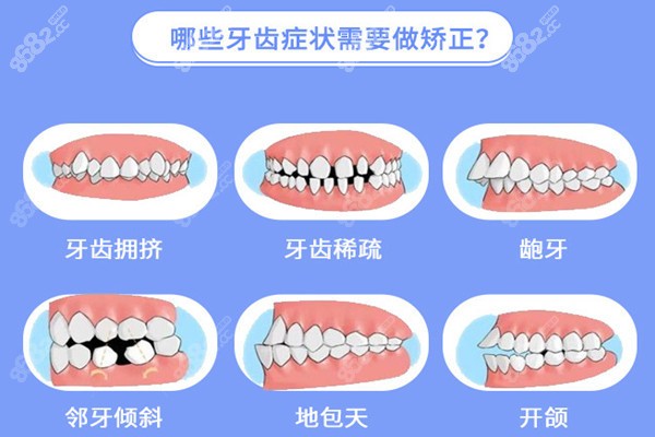 需要做矫正的畸形牙症状