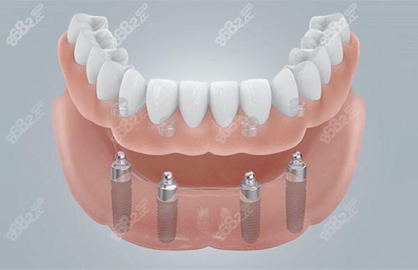 全口半固定种植牙