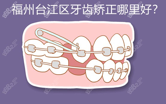 福州台江牙齿矫正哪里好