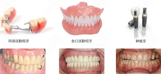 种植牙半固定和全固定的区别是什么