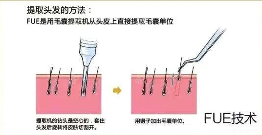 成都<!--<i data=20240705-sp></i>-->FUE植发技术