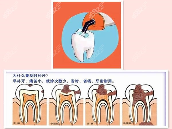 为什么要及时补牙图示