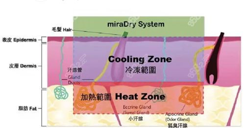 清新微波MiraDry去狐臭手术原理示意图.jpg