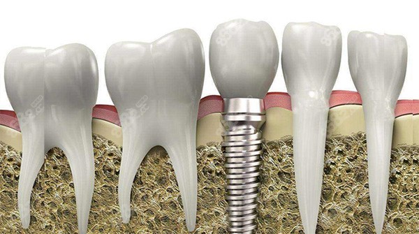 南陽(yáng)口腔醫(yī)院種植牙價(jià)格表 南陽(yáng)口腔醫(yī)院種植牙價(jià)格表