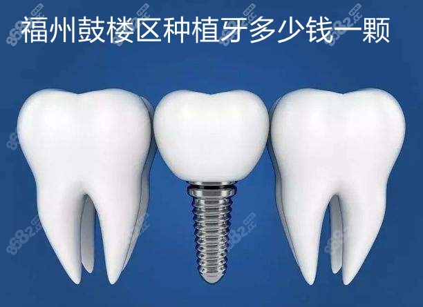 福州鼓楼区种植牙价格