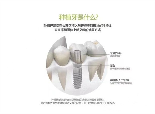 什么是种植牙，优势有哪些