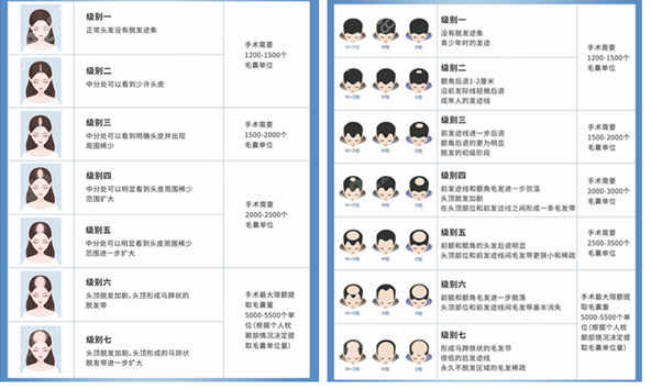 脱发等级图m.8682.cc