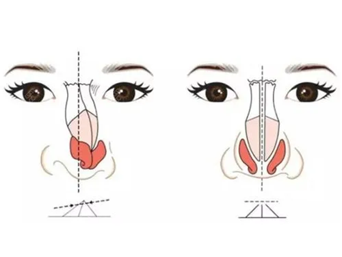 鼻修复选择哪种材料比较好？  
