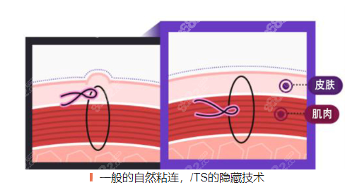 韩国TS整形外科使用隐藏技术