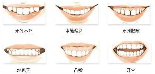 牙齿矫正适应症了解下
