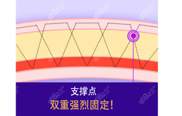 双重捆绑，自然粘连