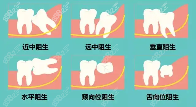 武汉拔智齿价格