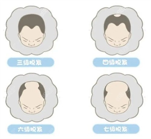 南昌佳美整形脱发示意图