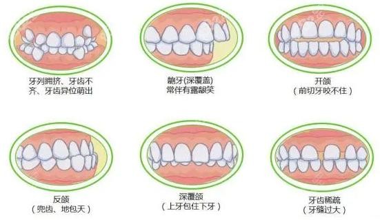 口腔牙齿矫正适应人群示意图