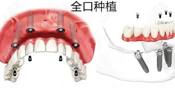 全口种植牙过程图