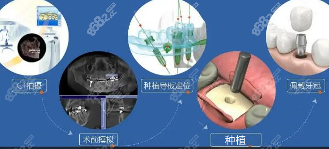 福州美可普3d数字化种植牙技术