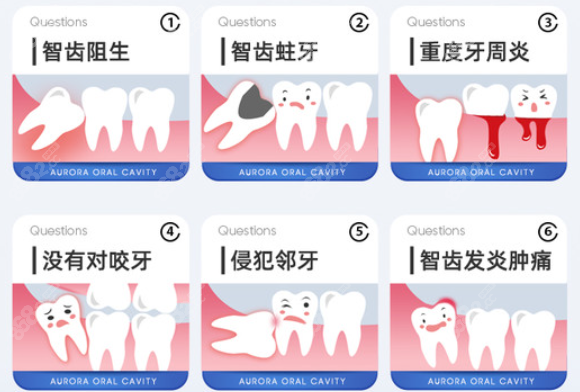 兰州德尔牙科可以拔的智齿类型