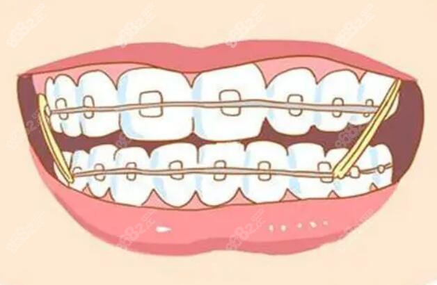 牙齿矫正卡通图