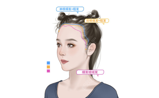成都首瑞不剃发技术