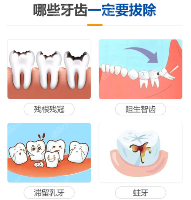 兰州哪个医院拔阻生智齿好