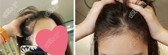 韩国黄盛柱女士发际线植发实例