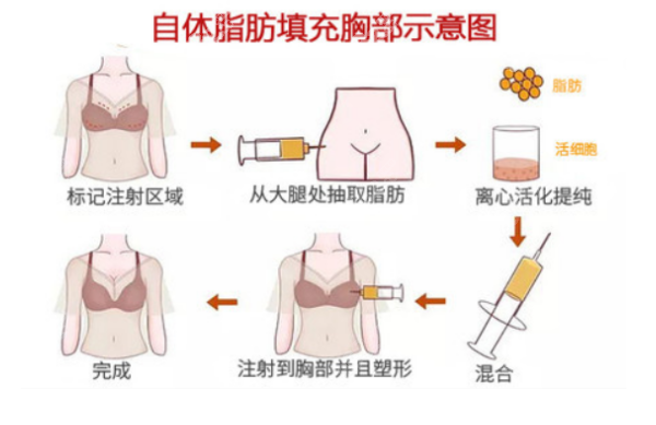 宁波自体脂肪隆胸多少钱