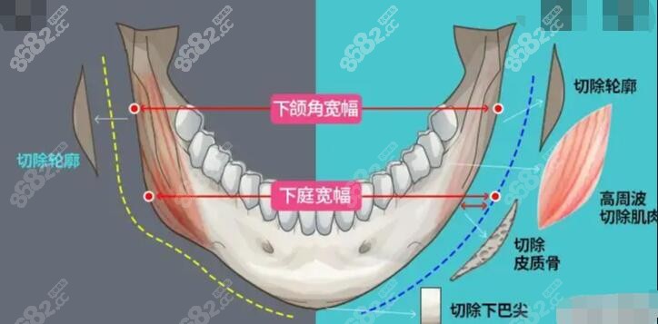 四川友谊<!--<i data=20240705-sp></i>-->磨骨怎样