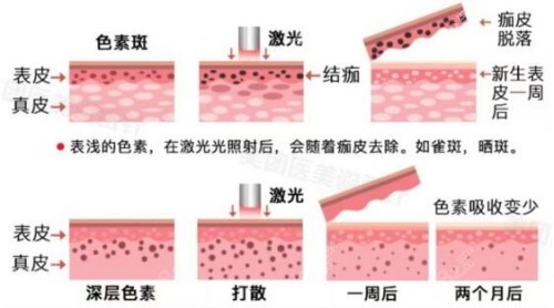 激光祛斑