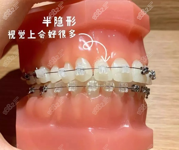 大连口腔医院半隐形矫正多少钱