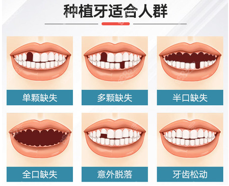 贵港蓝天口腔常做的种植牙类型