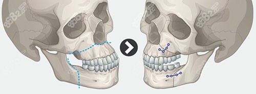 正颌手术过程图