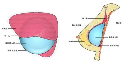 广州许杨滨假体隆胸技术特色