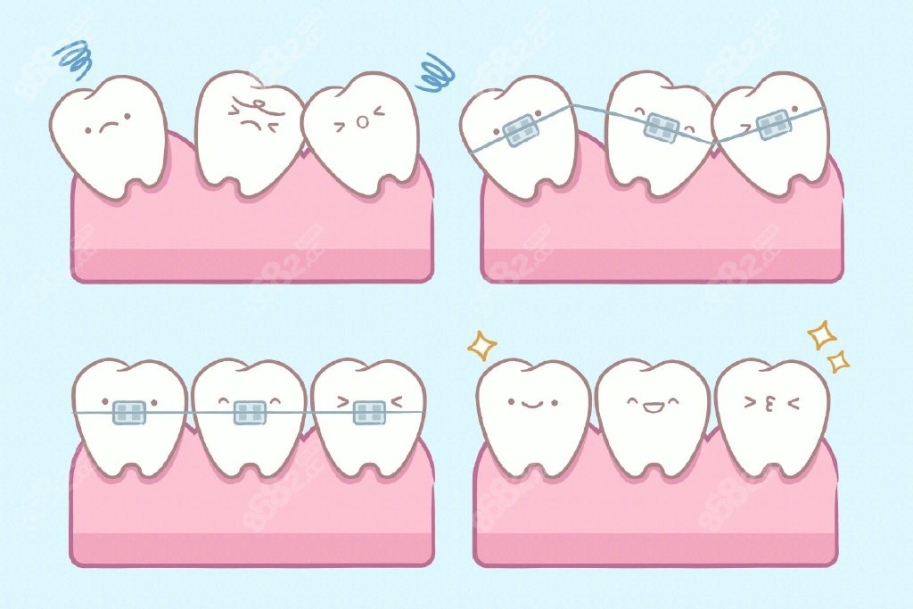 学生矫正牙齿多少钱