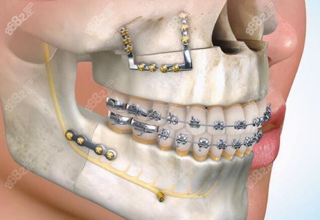 正颌手术过程图解
