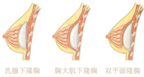 罗盛康隆胸需要排队吗？